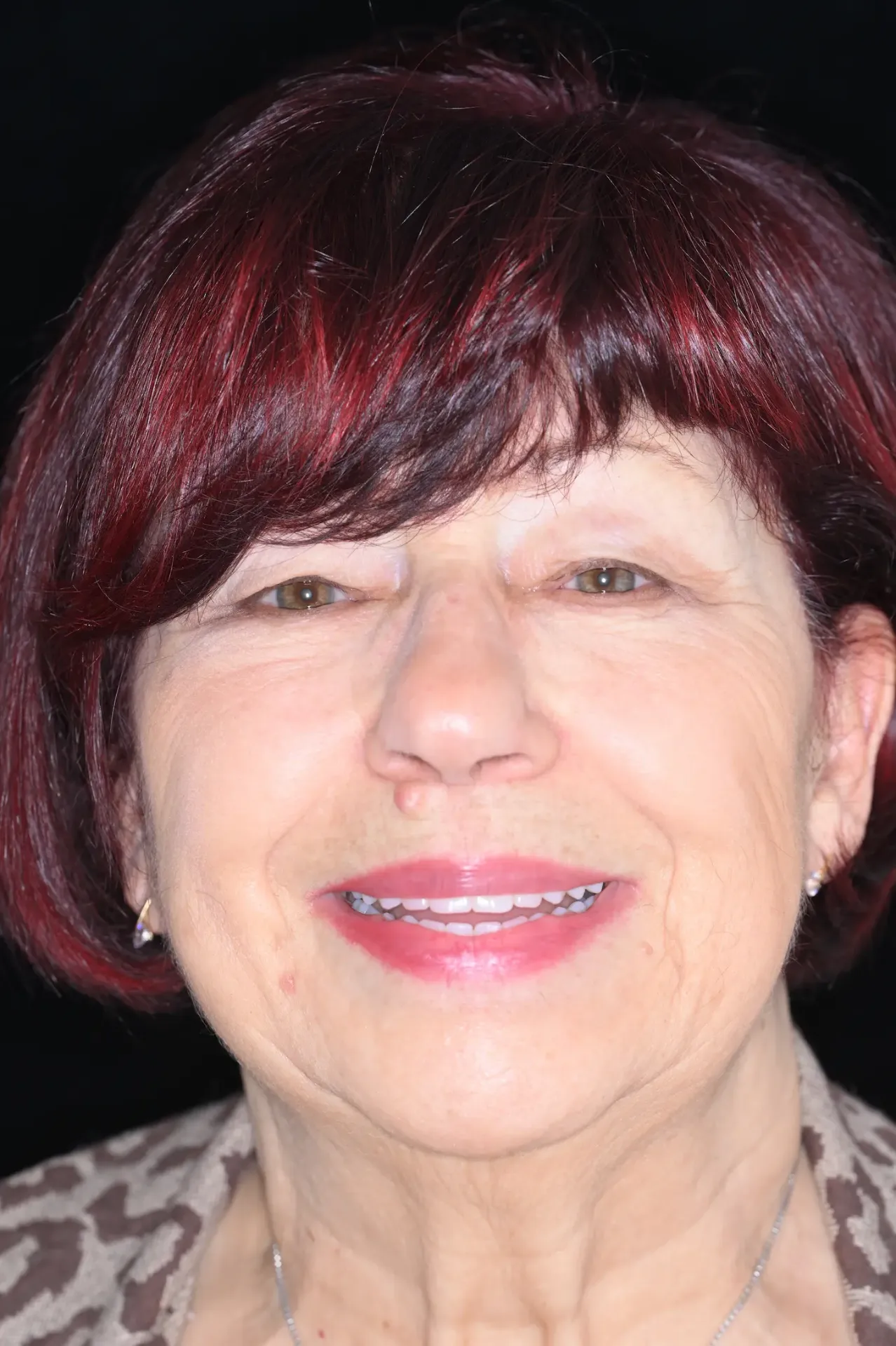 Loredana, paziente del Dott. Marco Caneva, sorride dopo la riabilitazione implantare completa eseguita nello studio dentistico di Trieste