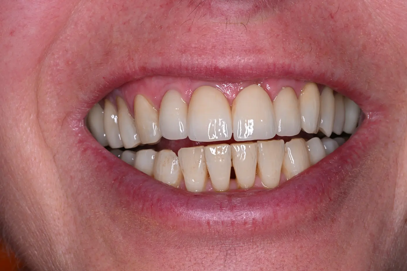 Daniela — arcata superiore con denti irregolari prima della riabilitazione estetica e funzionale a Trieste