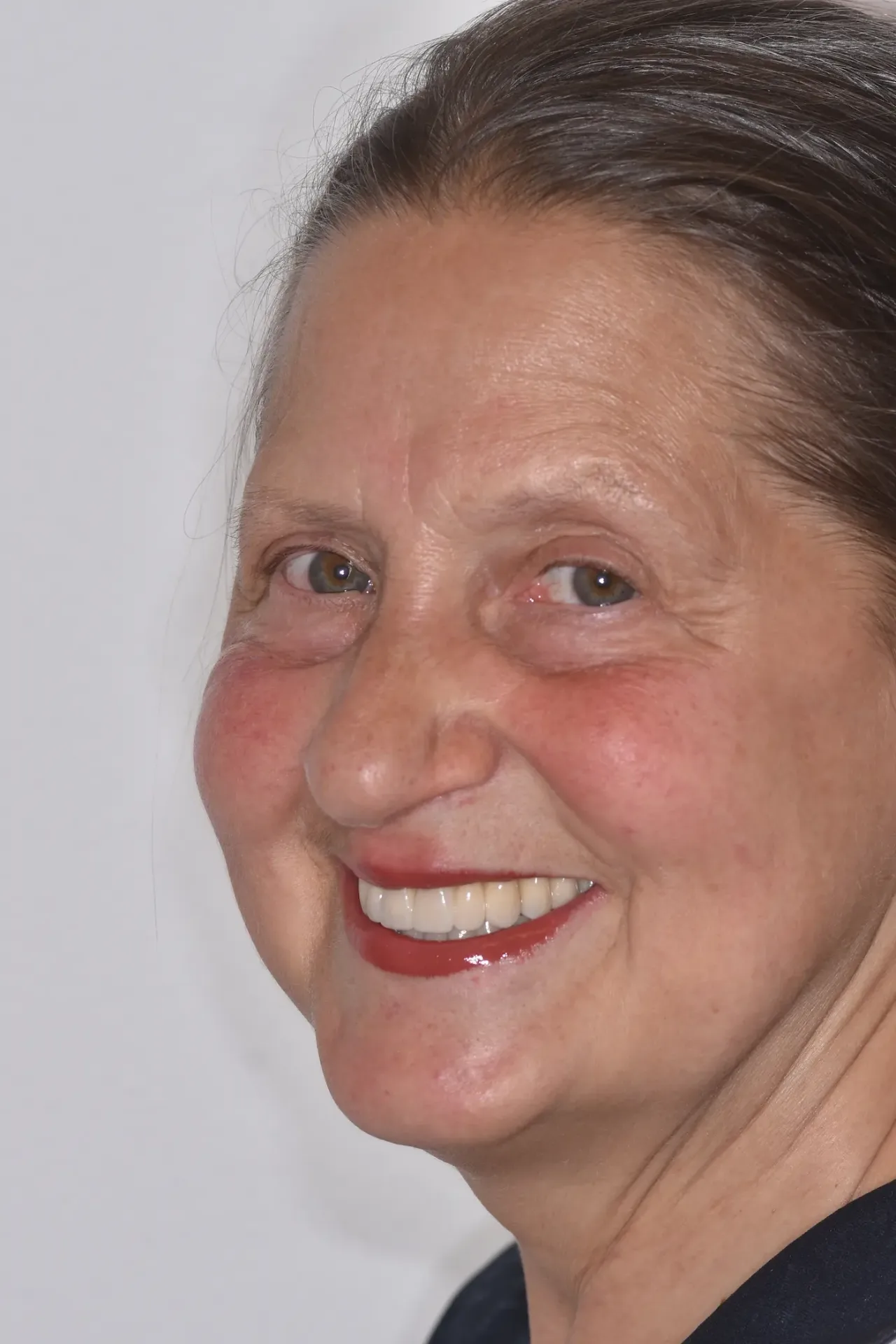 Luana dopo la riabilitazione su denti e impianti allo Studio Caneva di Trieste