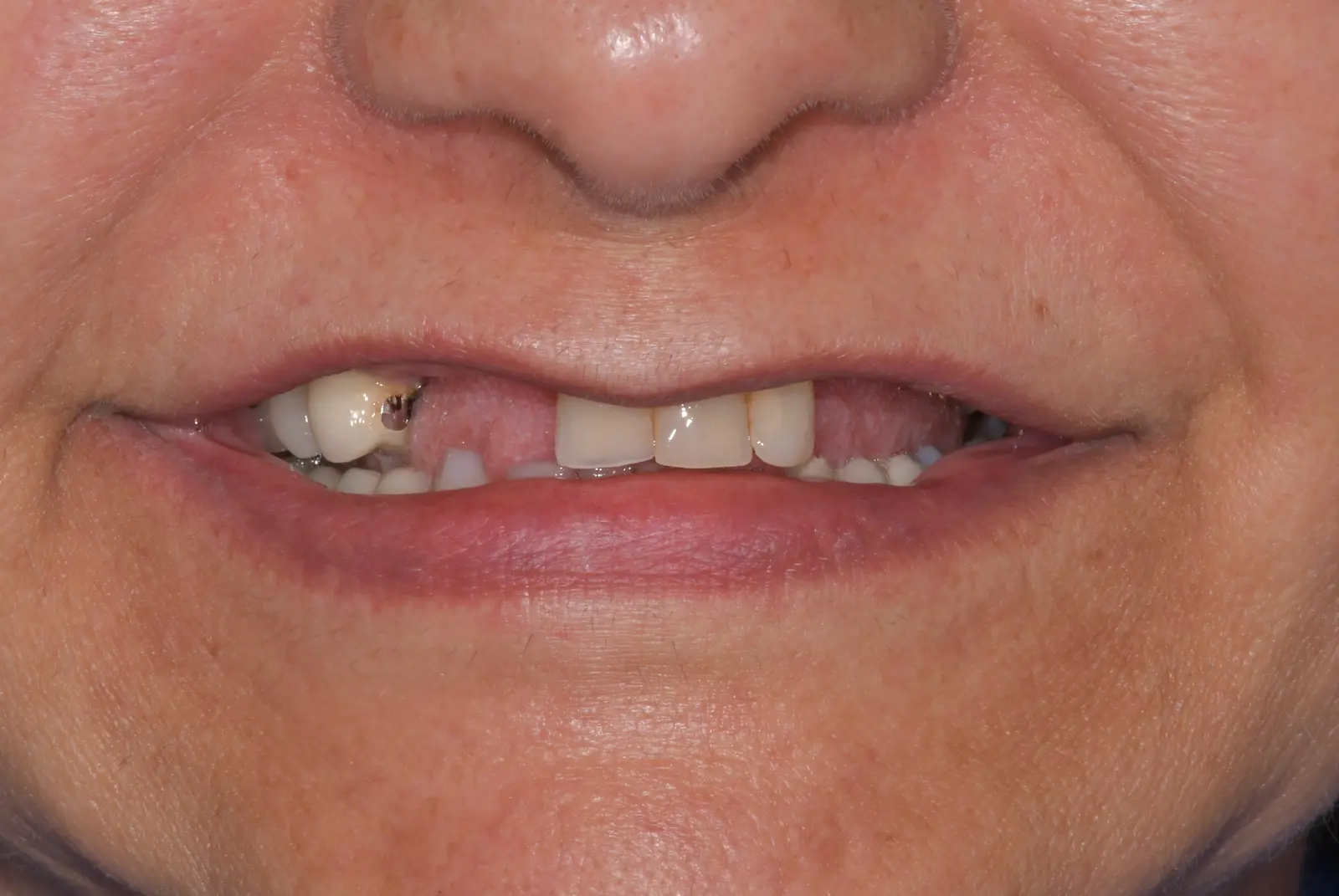 Situazione clinica iniziale di Maria de Fatima: denti mancanti e compromessi prima degli impianti