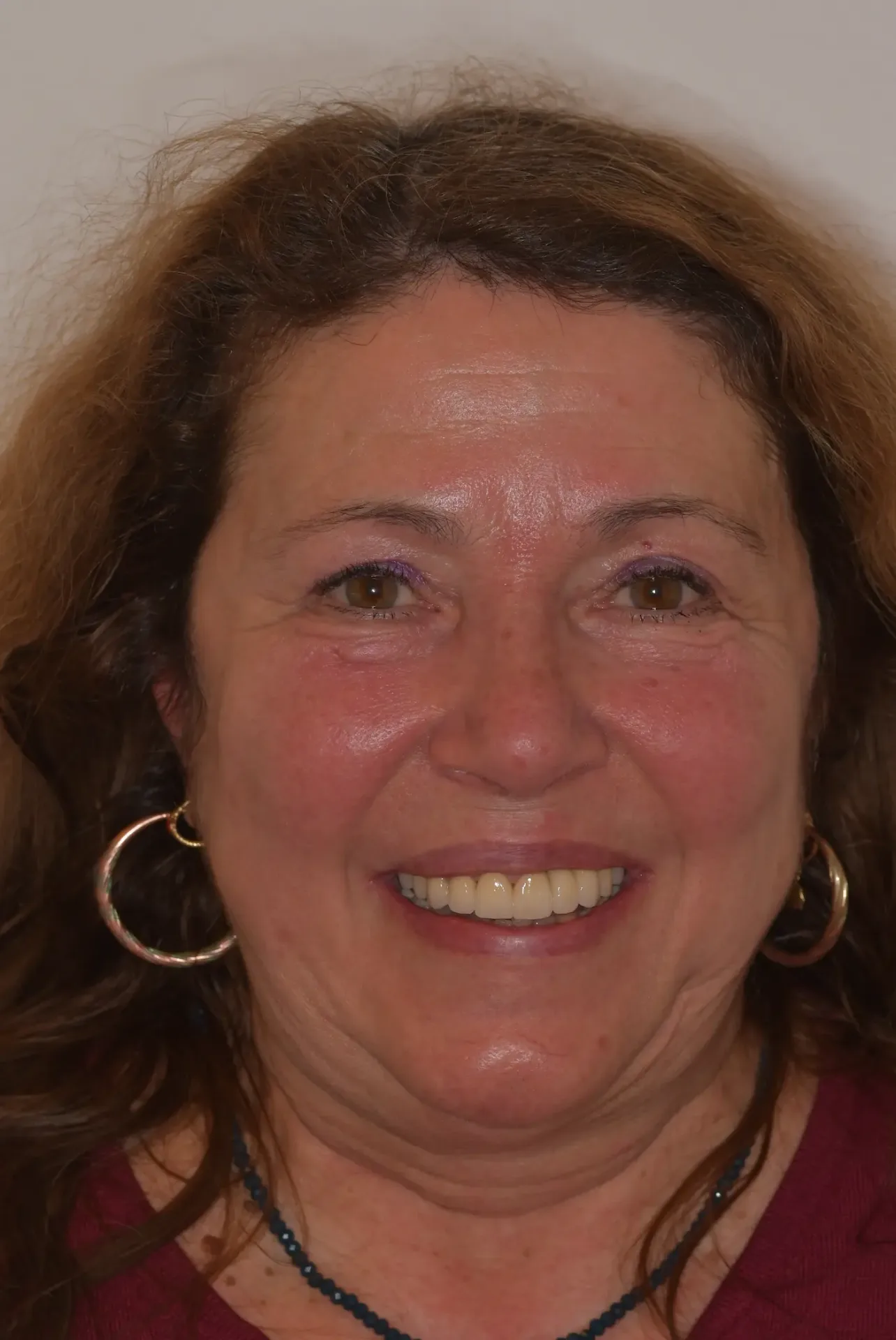 Tiziana dopo la riabilitazione dentale con impianti allo Studio Caneva di Trieste — sorriso ritrovato